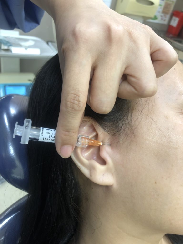 顳顎關節症候群
