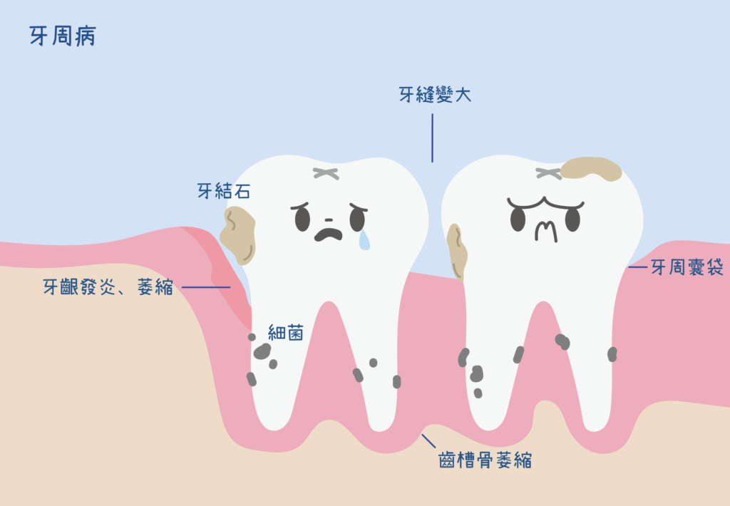 兩顆牙齒呈現的常見牙周病症狀