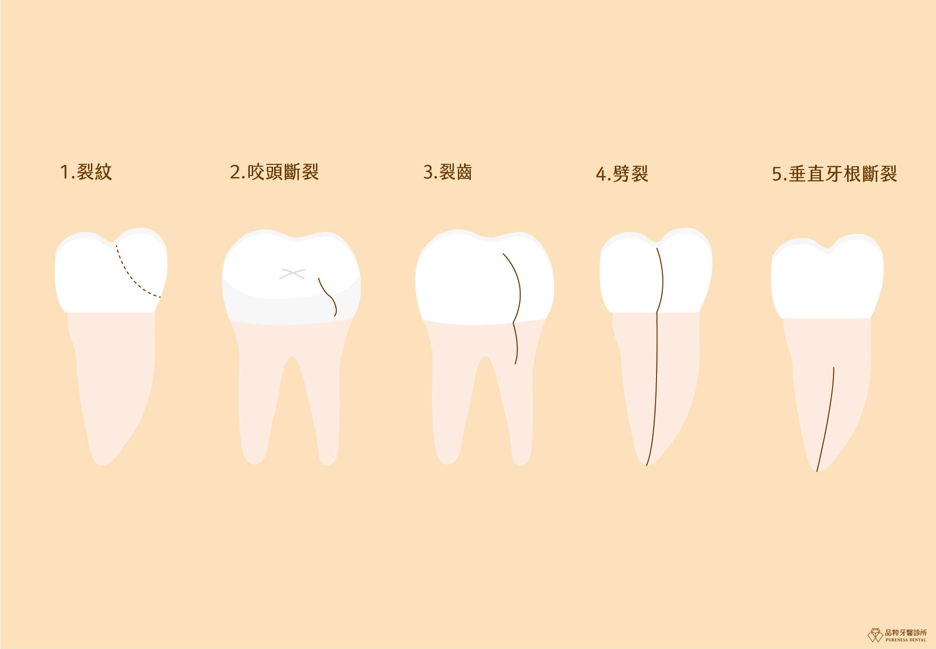 牙齒 表面 有 裂痕