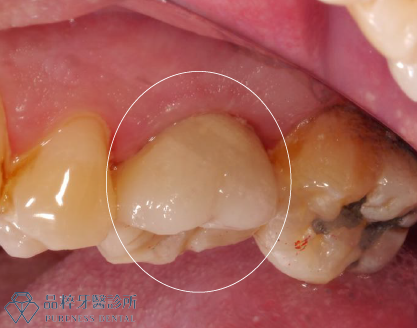 品粹牙醫後牙全鋯冠側面照