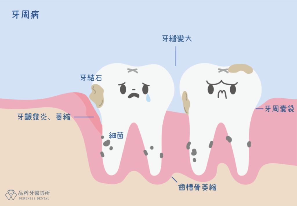 品粹牙醫牙周病常見症狀