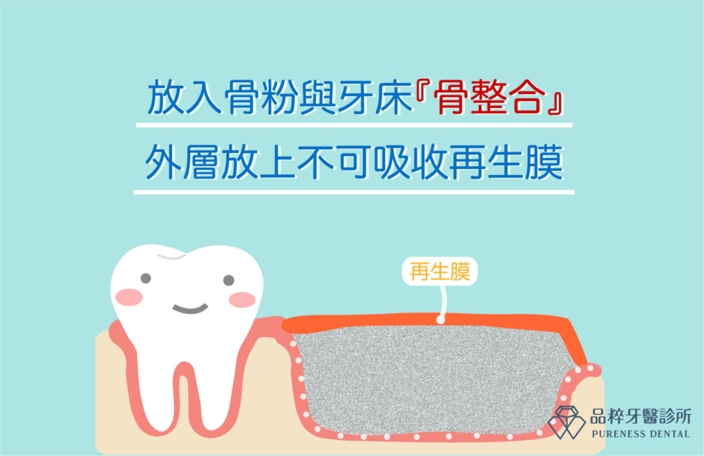 放入骨粉與牙床『骨整合』
外層放上不可吸收再生膜