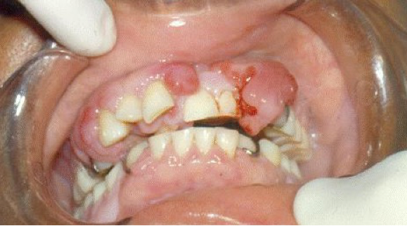 為使用鈣離子阻斷劑之病人牙齦
來源於參考資料中標示