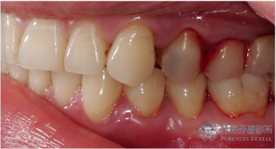牙根凹陷造成敏感不舒服、牙齦流血
品粹牙醫診所/徐孟弘醫師提供
