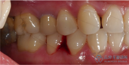 清潔非常乾淨的口腔，但是牙齒靠近牙肉處有些微的凹陷
品粹牙醫診所/徐孟弘醫師提供