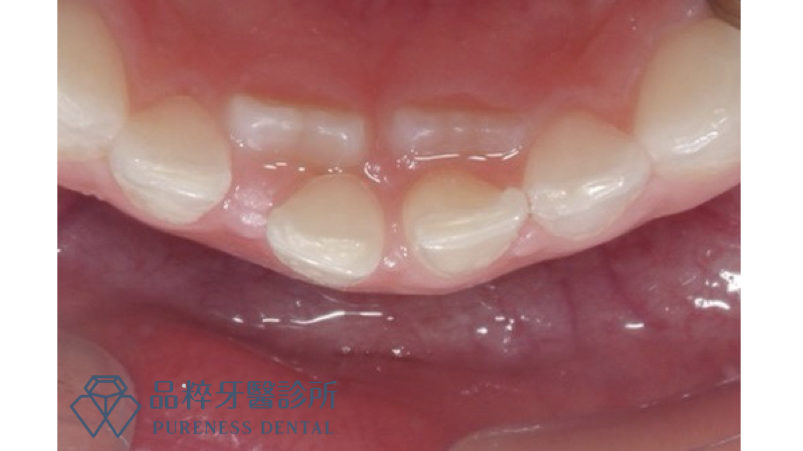 當孩子開始長牙，下排出現兩排牙齒
品粹牙醫許雯婷醫師提供