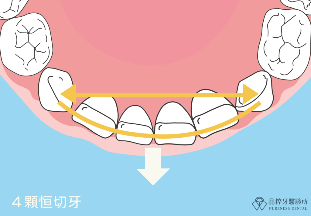 長四顆恆門齒後，牙弓寬度及彎曲度會自然增大-品粹牙醫診所