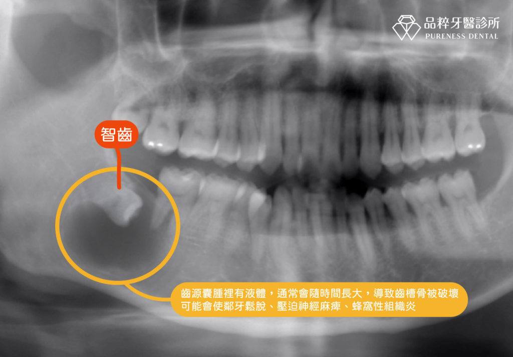 含齒囊腫的環口Ｘ光片