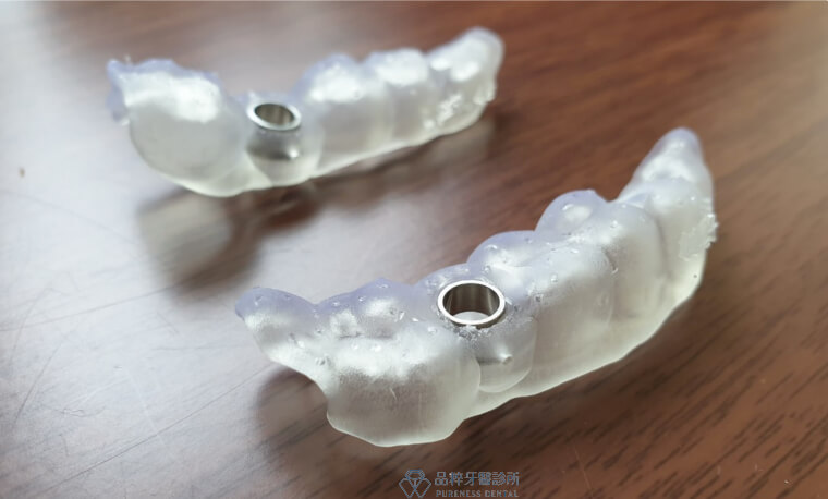 新竹牙醫3D影印的植牙手術導引板