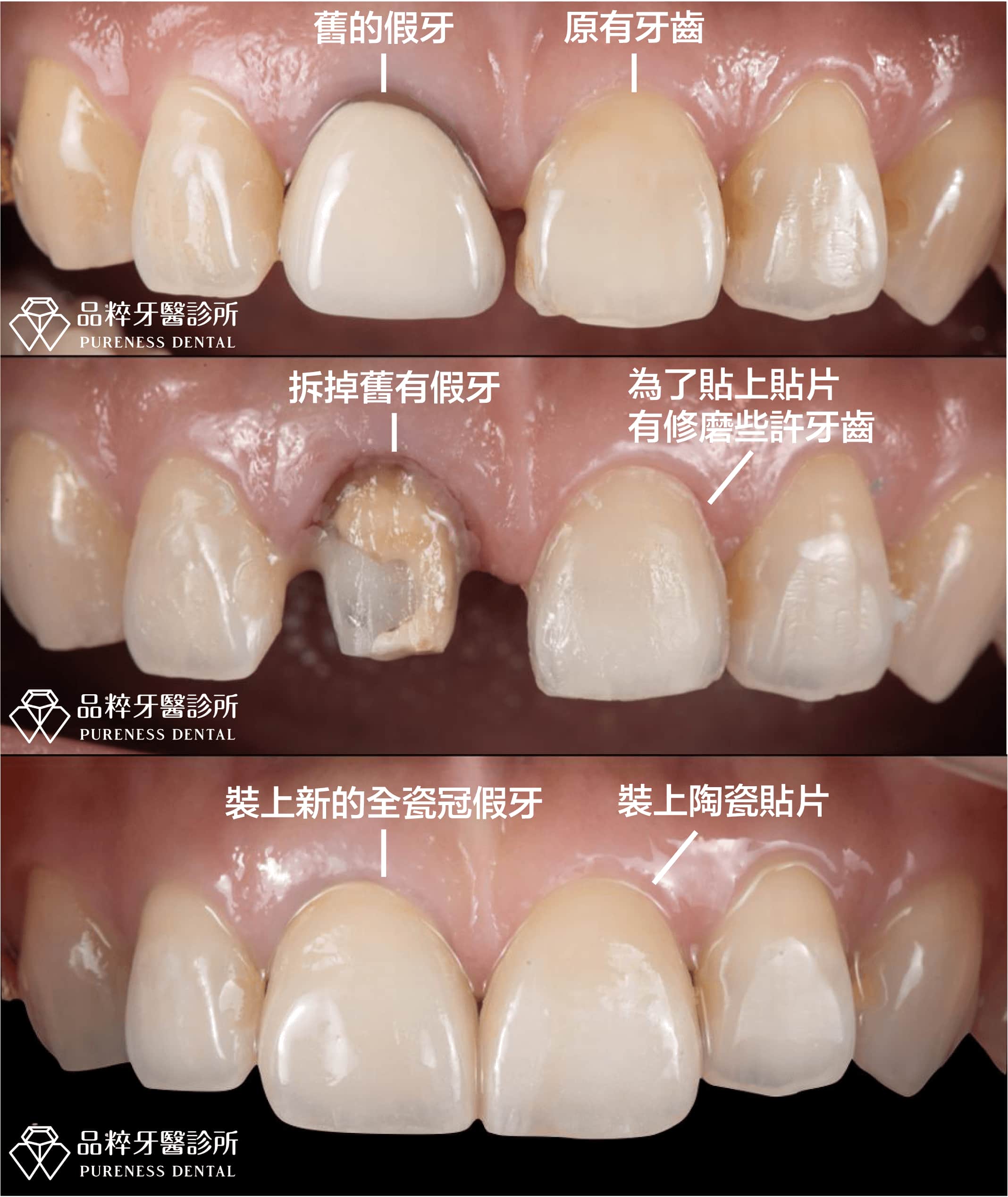 艾來牙醫: 從容的自信-全陶瓷牙冠修復外型