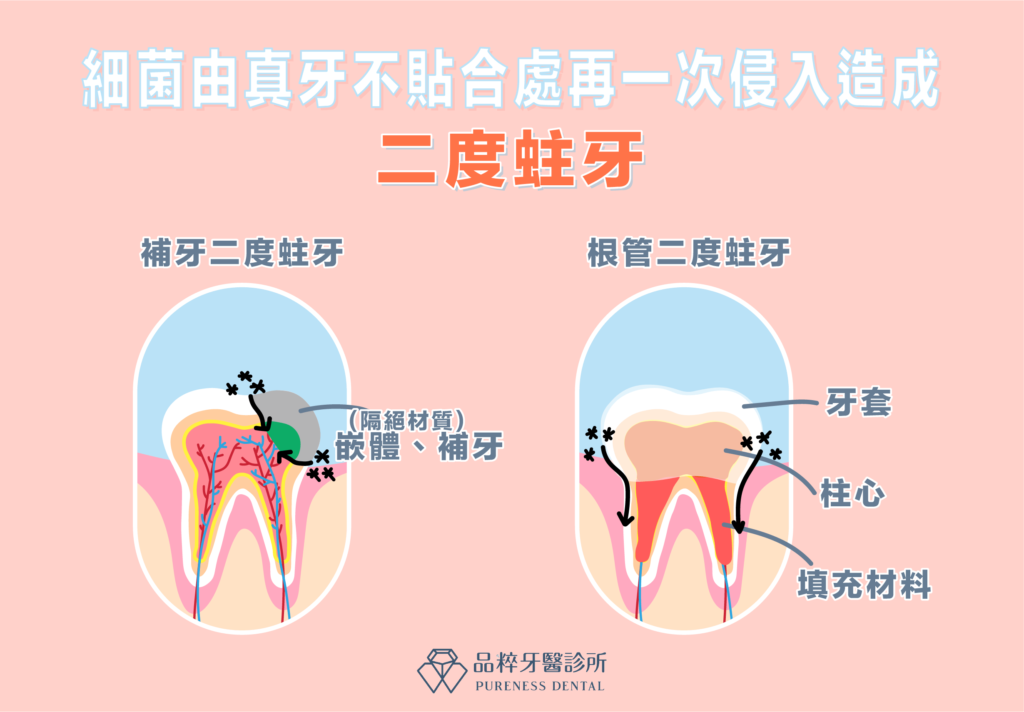 真牙不貼合處導致二度蛀牙、品粹牙醫