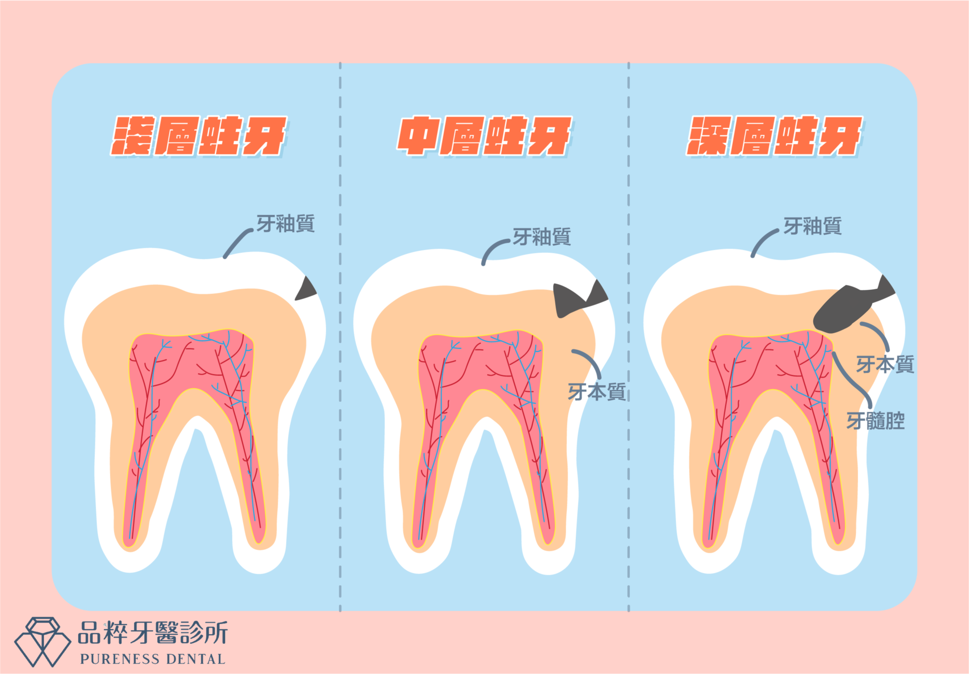 龋齿和蛀牙有什么区别？典型症状是什么？司恩图 - 知乎