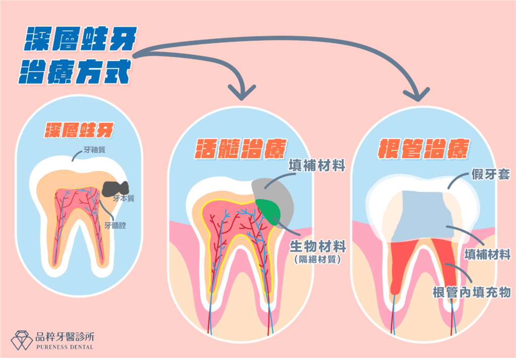 深層蛀牙治療方式：活歲治療或根管治療