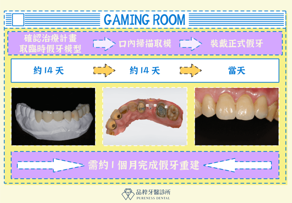 牙橋假牙流程
案例提供：品粹牙醫 劉東翰醫師