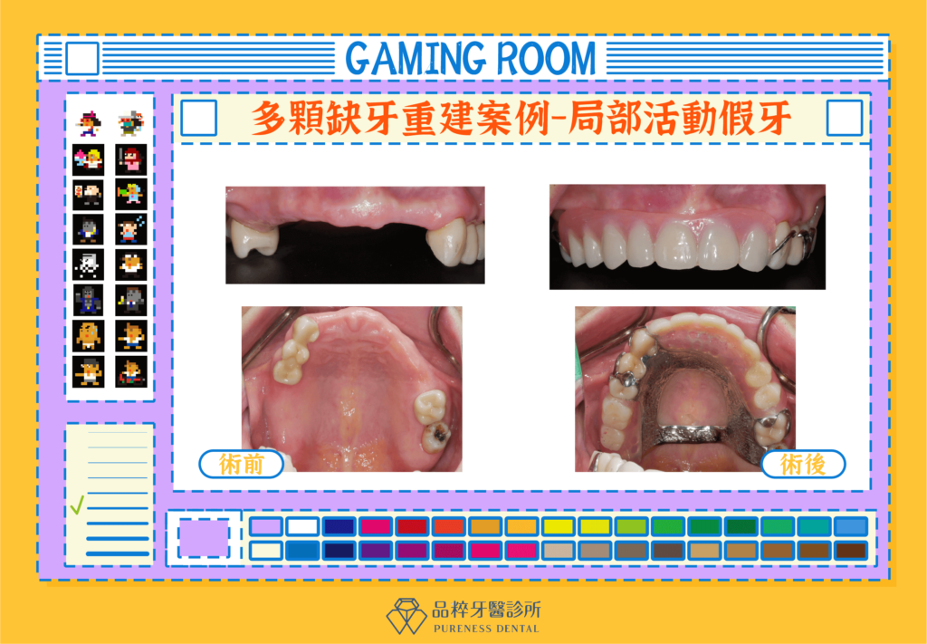 多顆缺牙重建案例-活動假牙
案例提供：品粹牙醫 劉東翰醫師