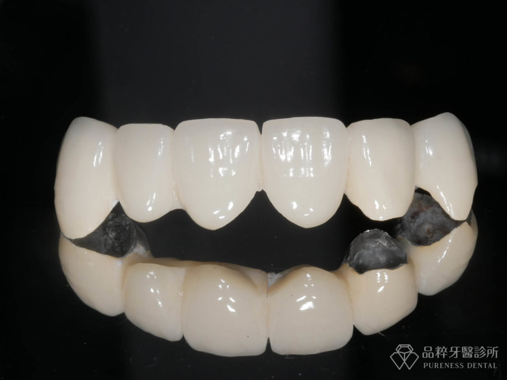 內層貴金屬外層燒瓷假牙
案例提供：品粹牙醫