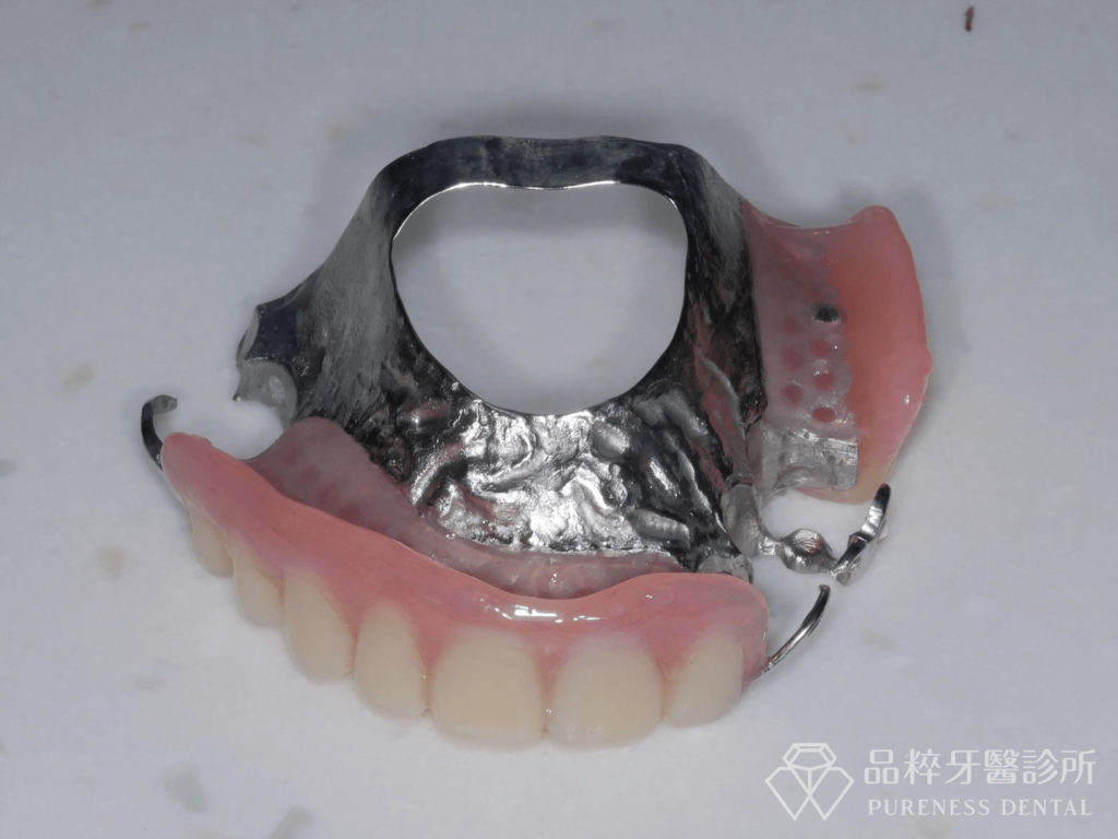 局部活動假牙
案例提供：品粹牙醫