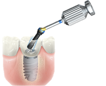 螺絲型假牙
案例提供：品粹牙醫