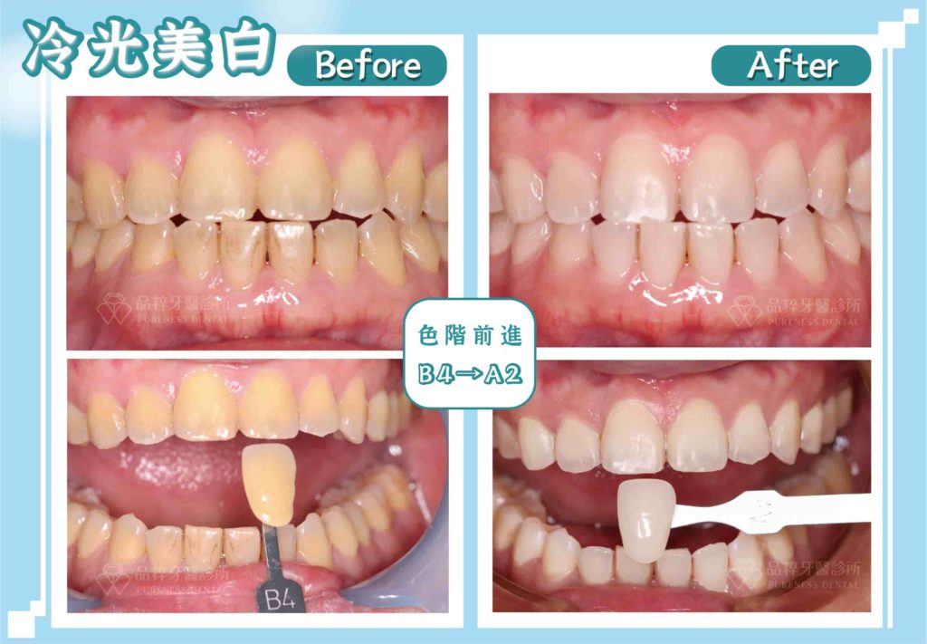 冷光美白的最大優勢：短時間牙齒色階可以明顯進步
案例提供：品粹牙醫 謝鈞皓醫師 
