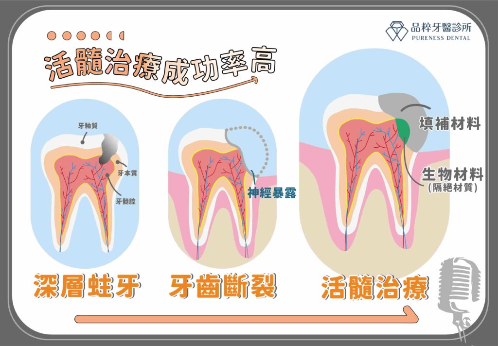 選擇活髓治療常見狀況有深層蛀牙、牙齒斷裂，其長期成功率高。