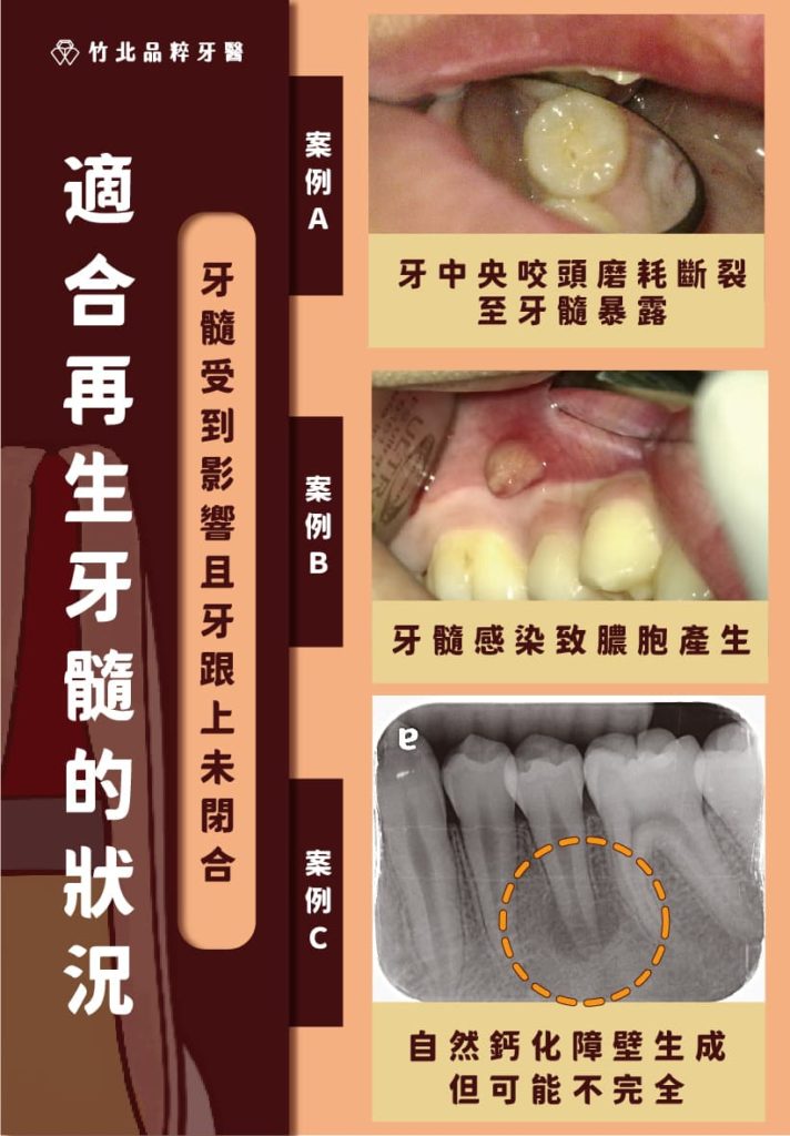 適合做再生牙髓的牙齒狀況：牙中央咬頭磨耗、牙齒斷裂導致牙髓暴露、牙髓感染致膿包、根尖發炎導致無法繼續生長及閉合