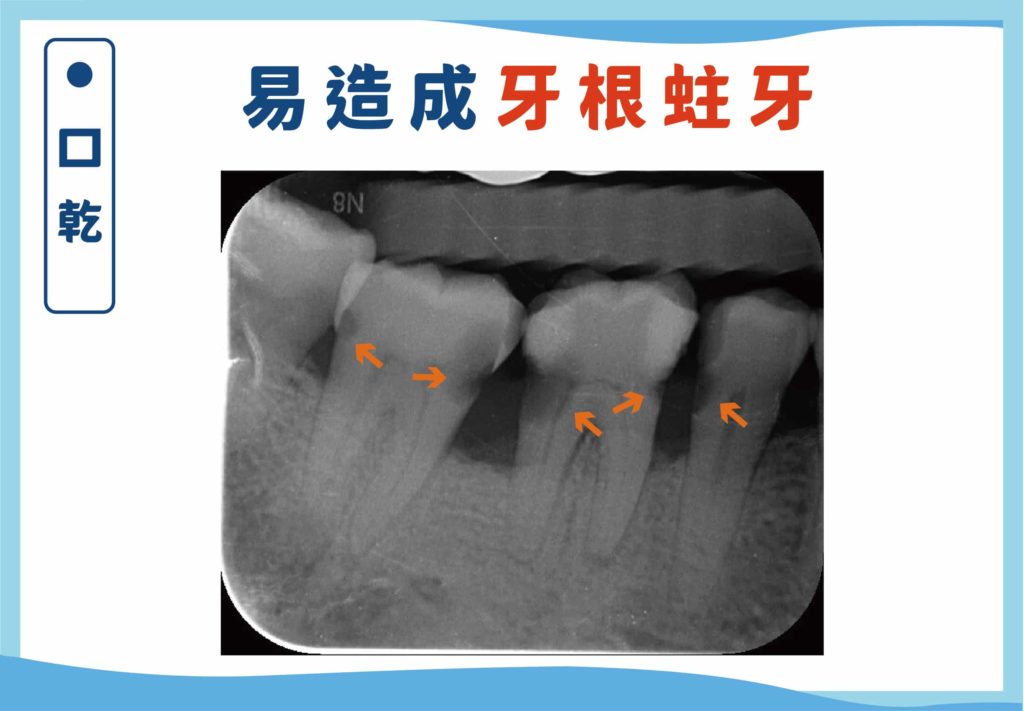 口乾可能會導致黏膜炎、齲齒（特別是在接近牙根的位置）。