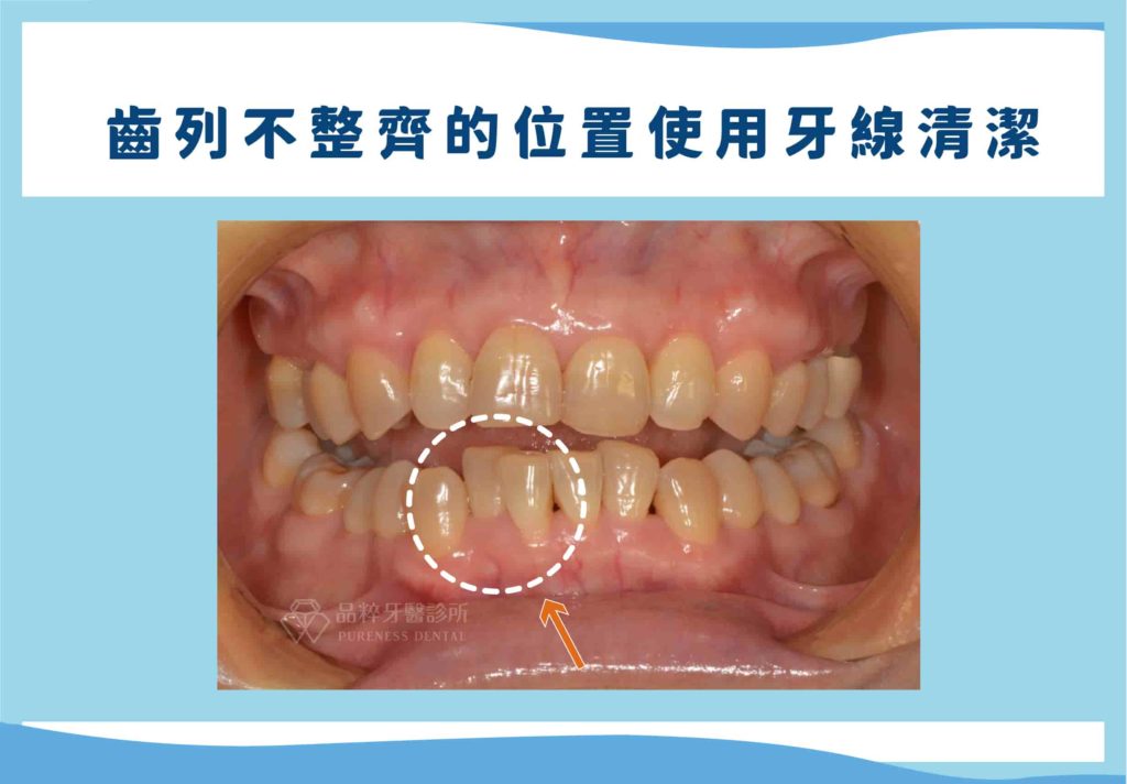 如果是齒列擁擠不整的位置，牙間刷無法順利放入則建議改用牙線，以免對牙齦造成不必要的傷害。