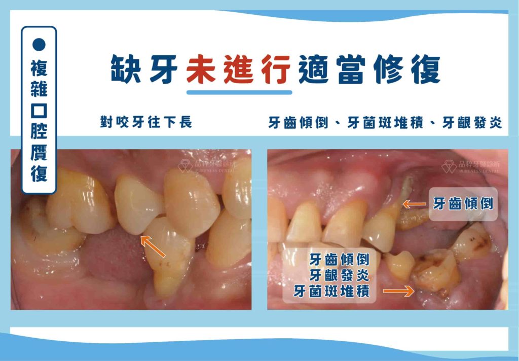 缺牙若沒有進行修復，鄰近牙齒會傾倒導致清潔不易，對咬牙長長使咬合變得不穩定，甚至侵犯到正常修復空間。
