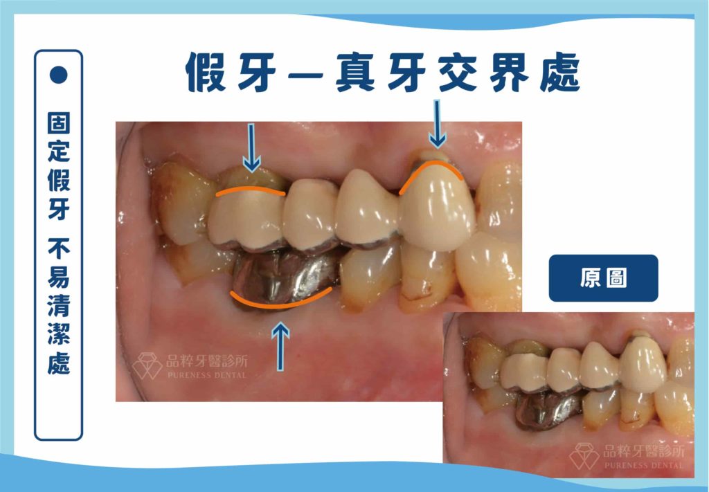 邊緣再蛀牙是常見造成舊有牙套/牙橋需移除的原因，平時清潔這類固定假牙需特別注意刷到假牙—真牙交界處。（配邊緣在蛀照片）