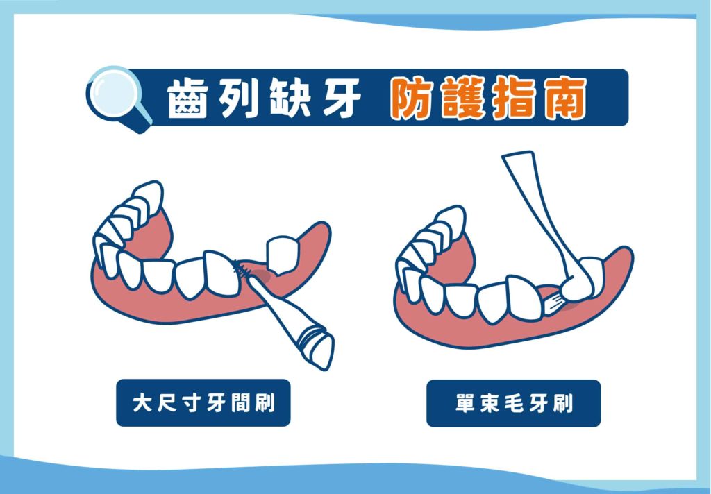 鄰近缺牙的位置通常牙刷無法有效清潔，建議使用大尺寸牙間刷或是單束毛牙刷。