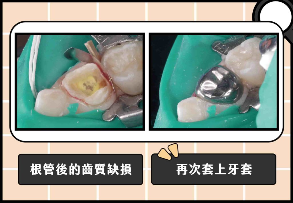 根管治療後，牙齒缺損，並且在當次治療套上牙套，有效避免牙齒碎裂，提供牙冠良好的封閉性，隔絕該牙再次蛀牙。