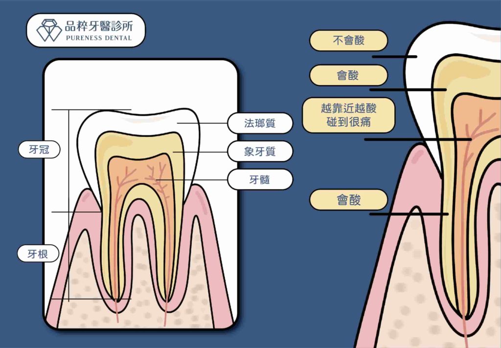 牙齒構造中具有通透性的管狀結構組成的牙本質、牙根，會因為受到刺激而讓人感到痠痛。