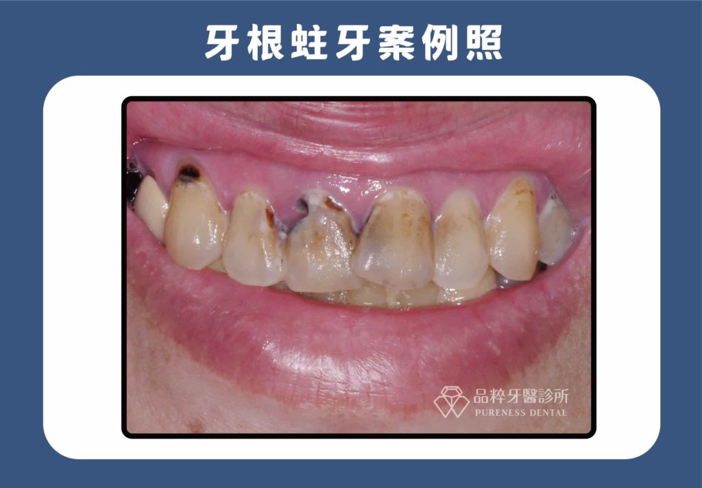 如果蛀牙發生在容易造成敏感的地方，像是牙根上或較深的牙本質中，大部分都會造成敏感。