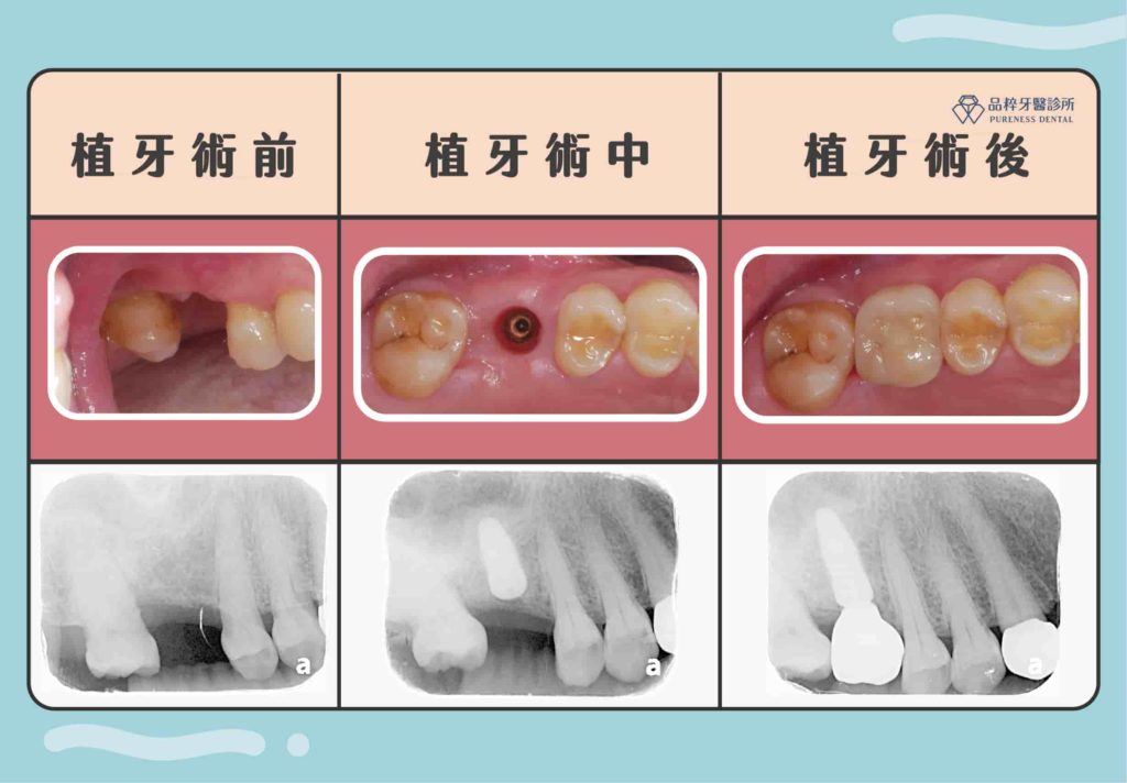 植牙的術前、術中、術後案例照