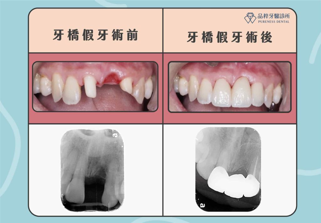 牙橋假牙術前術後對比案例