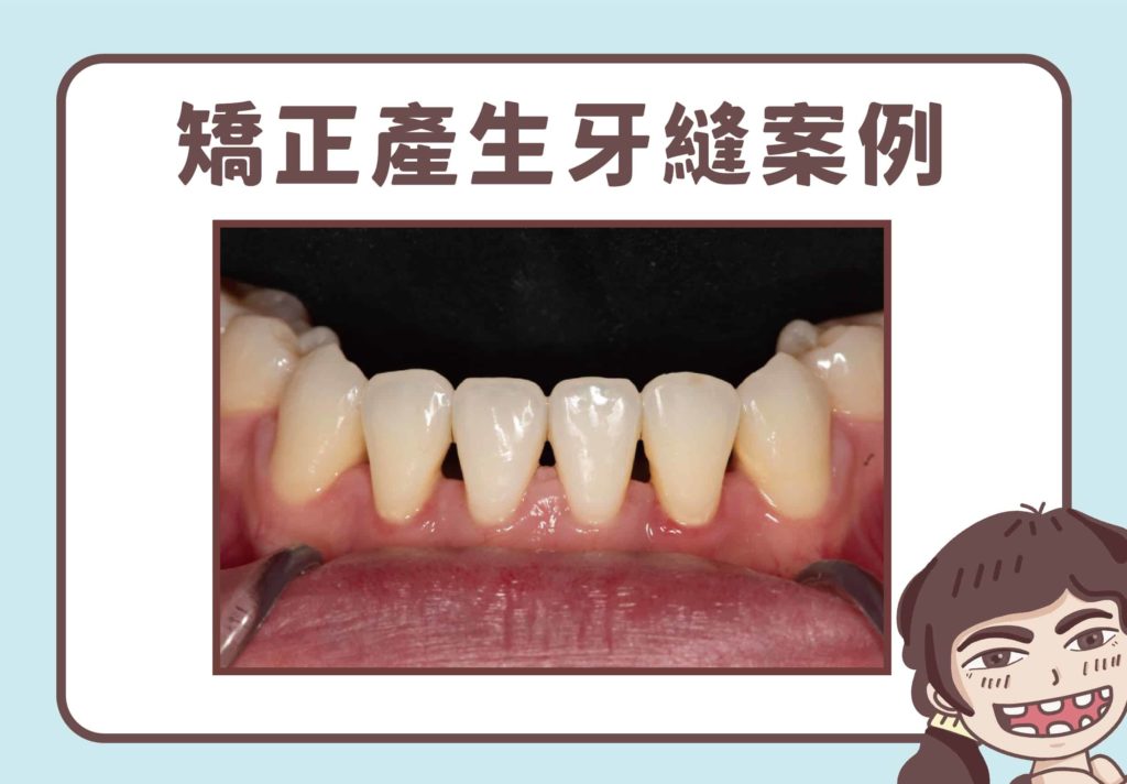 許多成人矯正後，會面臨黑三角牙縫的狀況。通常會出現在齒列過於擁擠、牙齦本身就有萎縮、牙齒形狀偏三角形的患者身上。
往往將牙齒排列整齊後，卻出現被原先凌亂牙齒遮蔽了的牙縫，也就是黑三角的狀況。