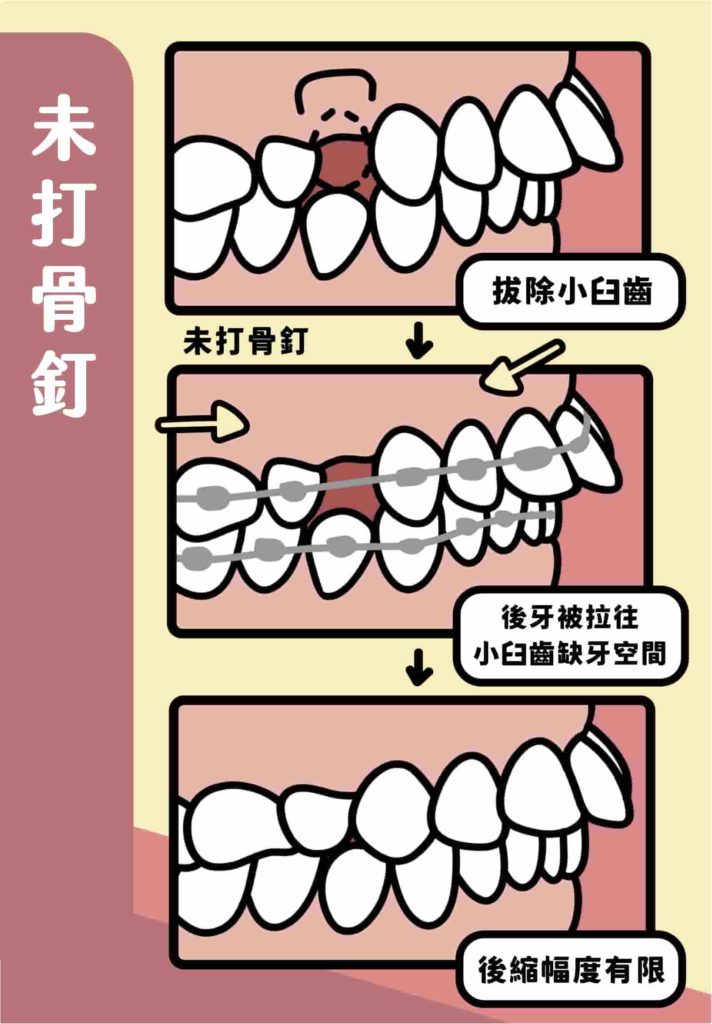 當我們用拔牙改善暴牙時，拔除一個小臼齒的寬度也才7-8毫米，但我們希望前牙可以完全退進小臼齒的空間，同時在退前牙的時候，後牙也會被前牙拉著往前跑，因此小臼齒的空間會被後牙吃掉了！如此一來，前牙退進來的程度就小很多，外觀上的改變也會比較少！
這時候骨釘就是用來拉前牙往後退，而不是用後牙拉前牙，前牙就可以輕鬆地完全退進去小臼齒空間了唷！