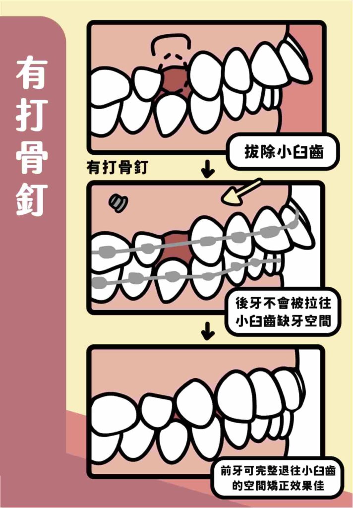 當我們用拔牙改善暴牙時，拔除一個小臼齒的寬度也才7-8毫米，但我們希望前牙可以完全退進小臼齒的空間，同時在退前牙的時候，後牙也會被前牙拉著往前跑，因此小臼齒的空間會被後牙吃掉了！如此一來，前牙退進來的程度就小很多，外觀上的改變也會比較少！
這時候骨釘就是用來拉前牙往後退，而不是用後牙拉前牙，前牙就可以輕鬆地完全退進去小臼齒空間了唷！