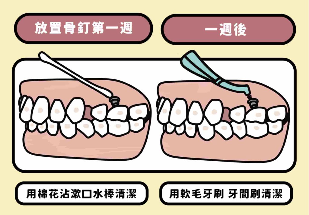 剛放置骨釘的第一個禮拜，洪醫師會請病患用棉花棒沾漱口水加強消毒骨釘位置。後續因為骨釘會容易卡食物渣渣，建議病患使用軟毛牙刷搭配牙間刷來清潔喔。把這骨釘當成我們口內的一顆小牙齒去照顧清潔就對啦！