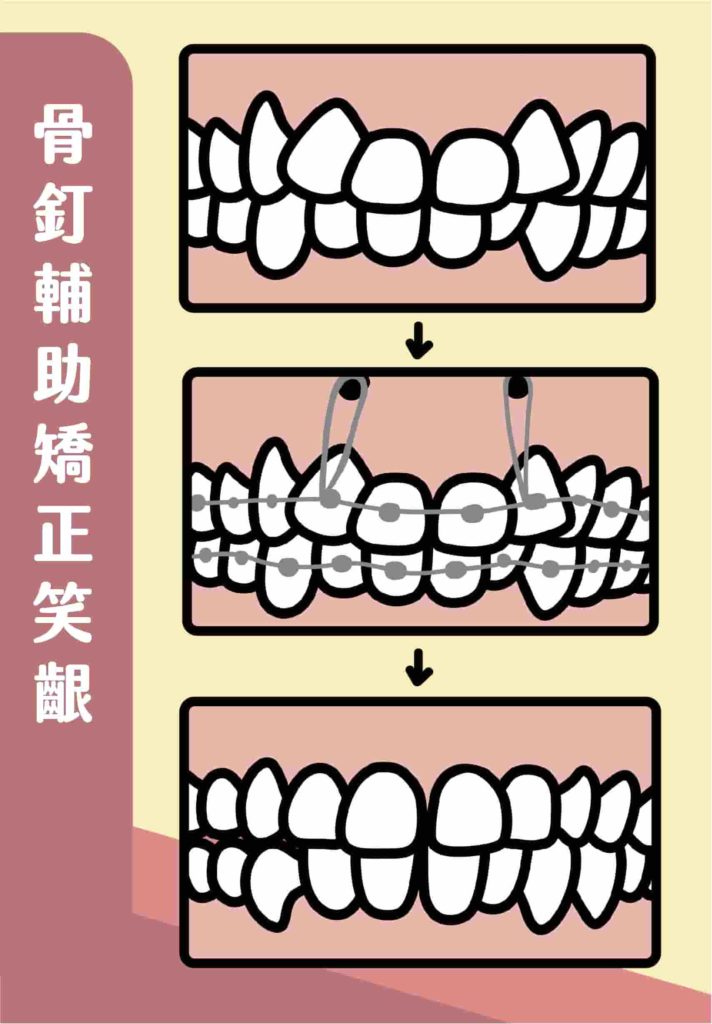 骨釘輔助矯正笑齦