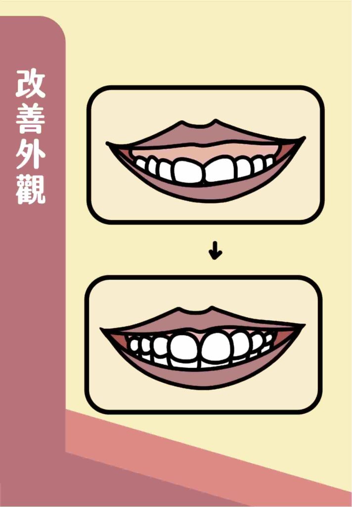 骨釘輔助矯正笑齦