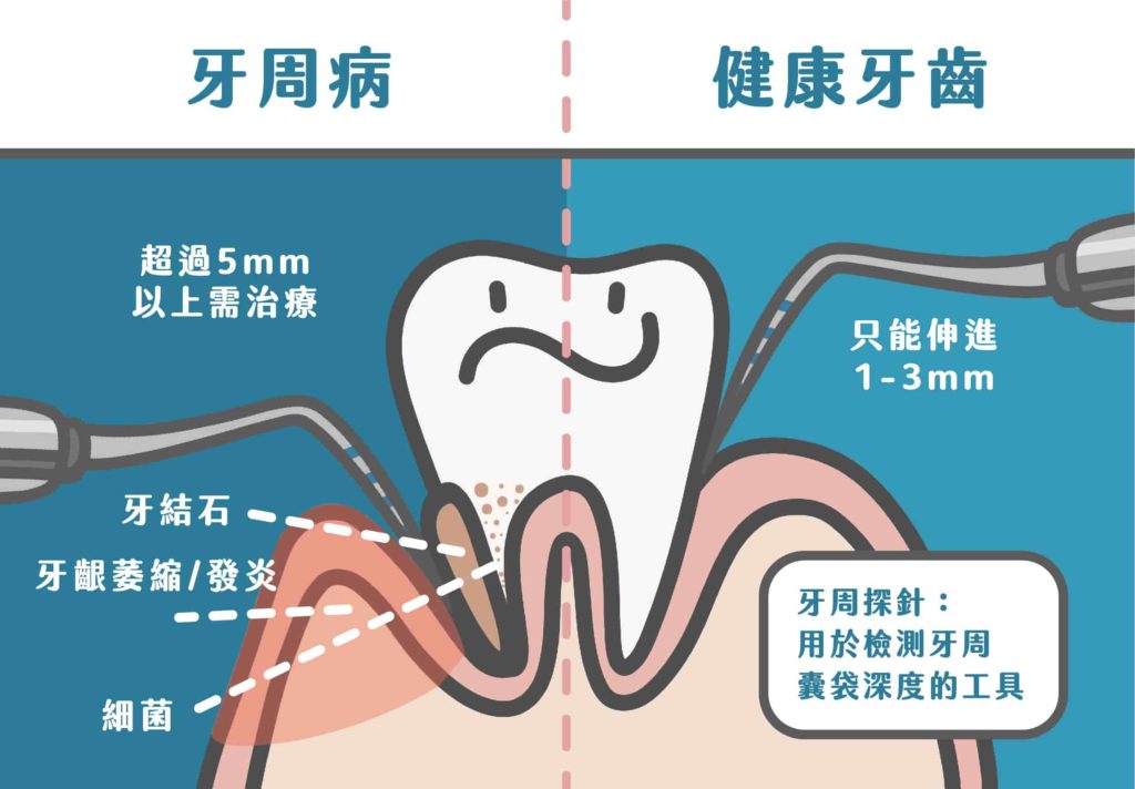 牙周病是由牙菌斑和牙結石引起的牙齒周圍組織的發炎性疾病。當牙周探針放入牙齦深度超過五毫米以上需要接受牙周病治療。