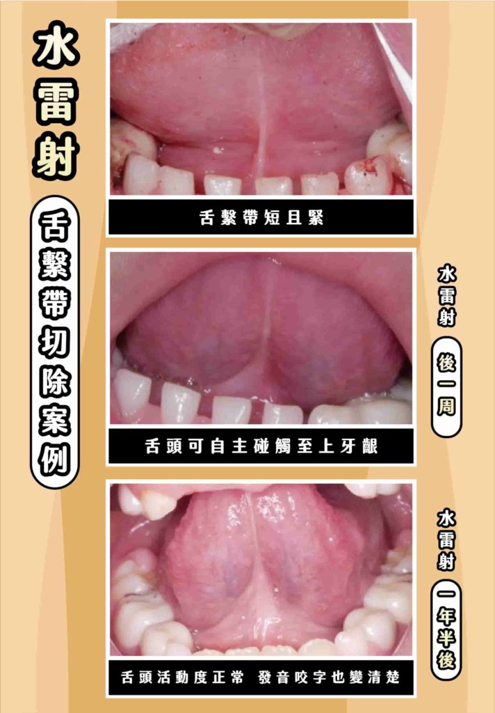 水雷射-舌繫帶切除案例