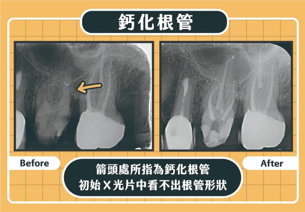 鈣化根管案例