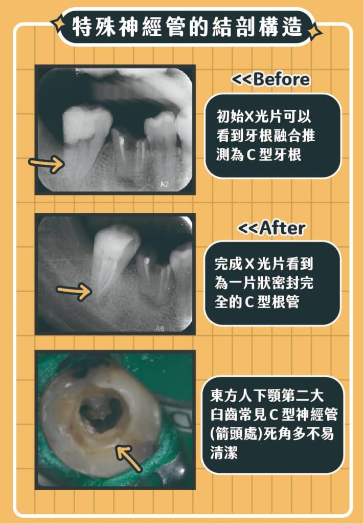 特殊神經管的解剖構造：C型牙根案例