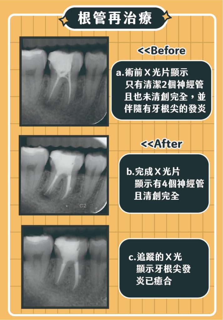 根管再治療案例