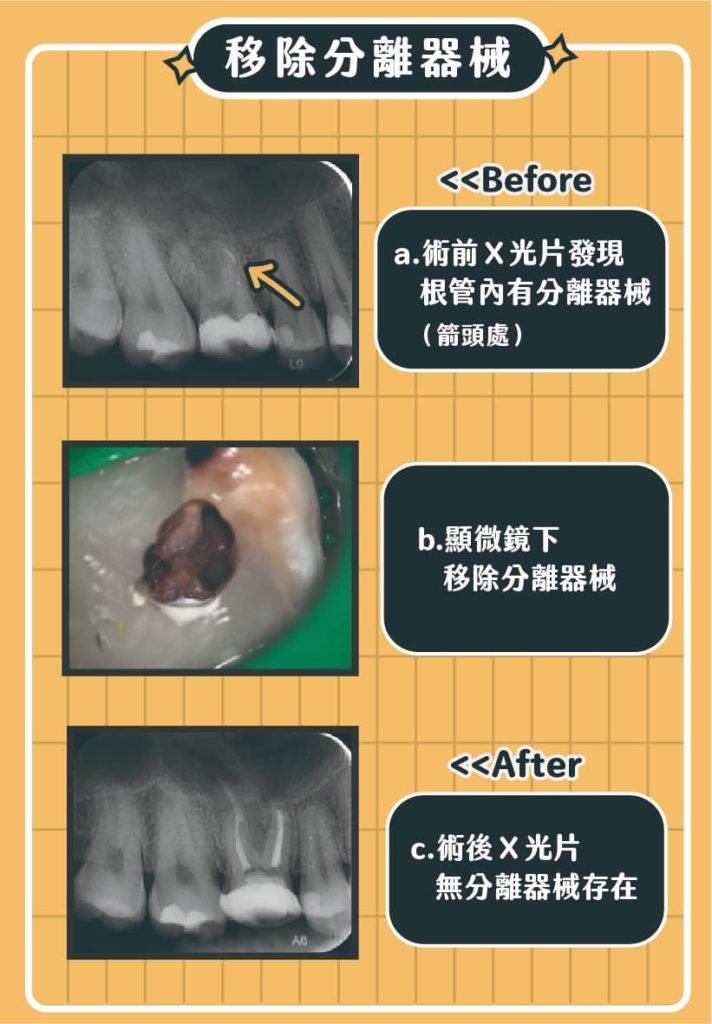 移除分離器械案例