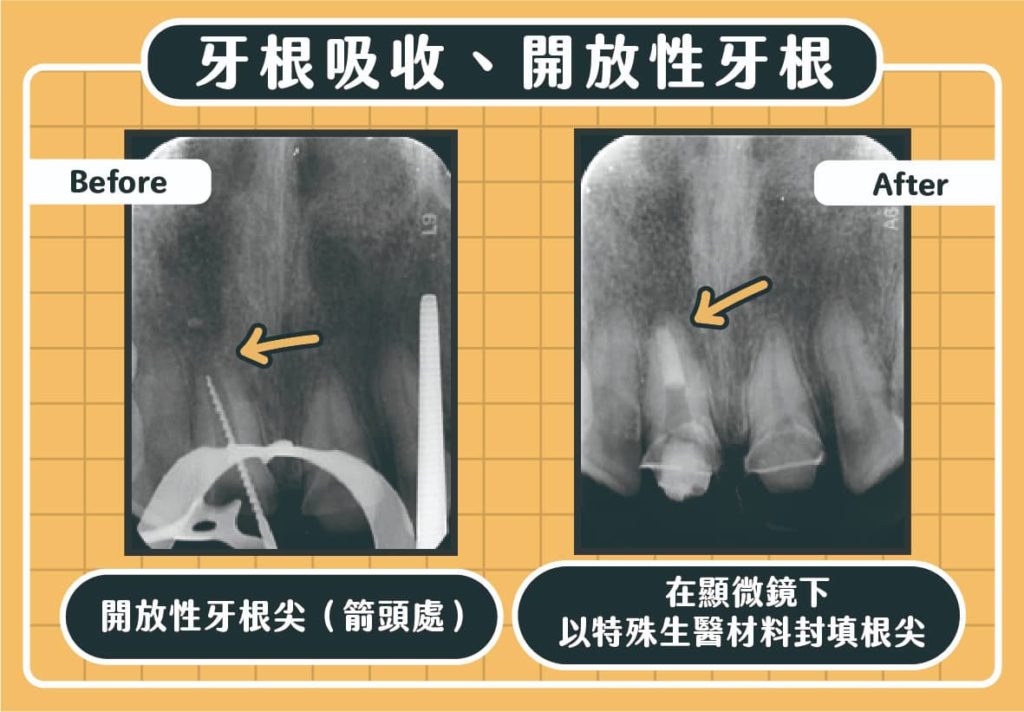 開放性牙根案例