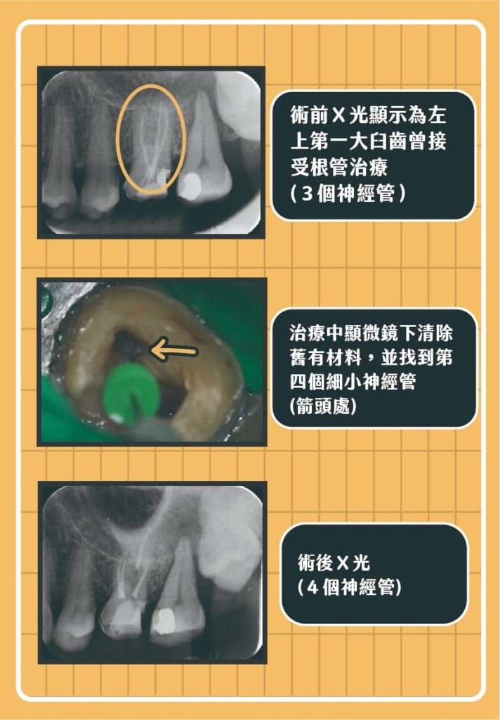 顯微根管治療案例，原先X光顯示第一大臼齒曾接受三個神經管的根管治療；治療中顯微鏡下清除就有材料，並找到第四個細小神經管；術後修復四個人經管。