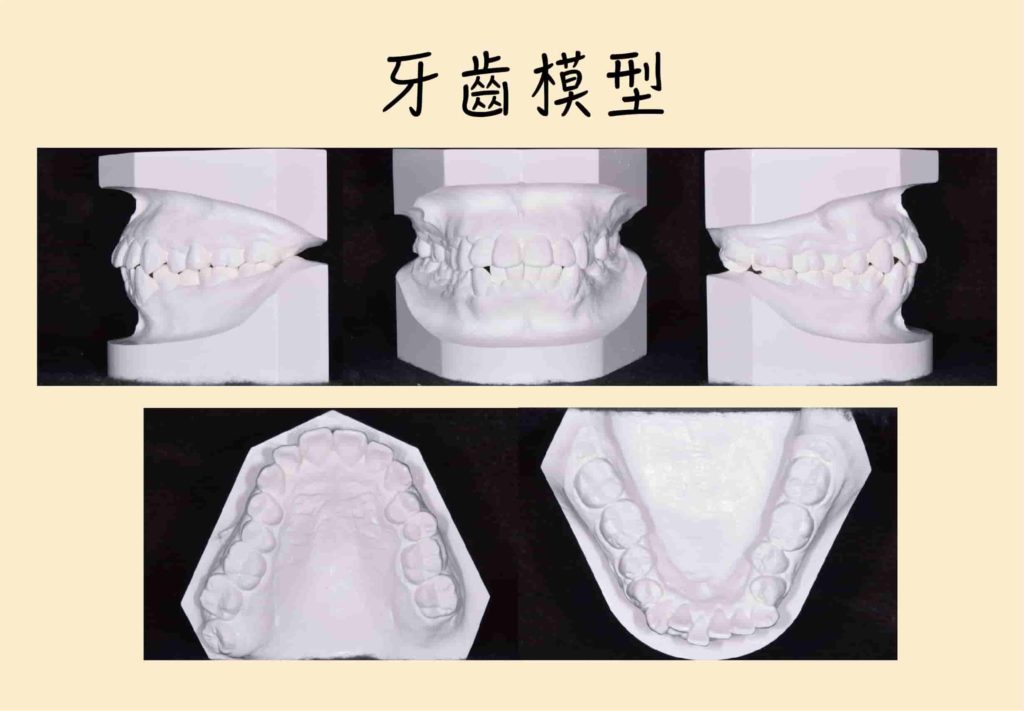 牙齒模型讓牙醫師更清楚地看到牙齒排列情況。